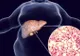 Steatoza hepatică: Cauze și simptome