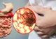 Boala Crohn. Principalele simptome
