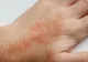 Dermatita atopică: simptome și cauze