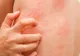 Urticaria acuta. Principalele semne