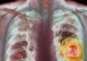 Cancerul pulmonar provocat de poluare. Descoperire de excepție a oamenilor de știință