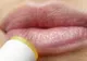Herpes la buză. Este sau nu contagios? Tratament