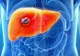 Primele simptome ale cancerului de ficat pe care mulţi le ignoră