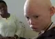 Povestea terifiantă a albinoșilor, talismanele morții: vânați ca animalele și vânduți pe bucăți