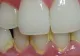Cum scapi RAPID de tartrul de pe dinți fără să mergi la dentist
