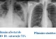 Cum arată plămânii unui tânăr de 23 de ani grav afectat de Covid-19. Avertizările specialiștilor