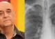 Ce este pneumonia de aspirație, boala care l-a ucis pe Benone Sinulescu. Cu toții facem greșeala asta ZILNIC!