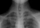 S-a dus la doctor, crezând că are tuberculoză. La analize, medicii au rămas muți! Ce pățise, de fapt, femeia - caz medical UNIC