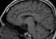 O boală neurologică misterioasă face ravagii printre tinerii canadieni. Ipotezele sunt HALUCINANTE