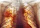 Adevărata dimensiune a dezastrului Covid. Cea mai detaliată radiografie dezvăluie cum arată, de fapt, plămânii după infectare - FOTO