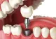 Ce trebuie să știi dacă ai nevoie de un implant dentar?