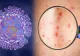 Se deschid centre de vaccinare pentru variola maimuței. Ce spun medicii din țara noastră