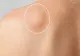 Dacă ai acest SEMN pe piele, mergi de urgență la medic. Cât de periculoase sunt lipoamele pentru sănătate
