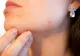 De ce apare acneea tardiva? Probleme de sănătate cu care te confrunți