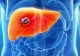 Primele simptome ale cancerului de ficat pe care mulţi le ignoră