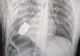 Medicii militari din Ucraina au scos o grenadă neexplodată din corpul unui soldat
