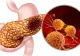 Testul de respirație care ar putea depista cancerul pancreatic