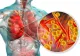 Semnal de alarmă îngrijorător: aproape 10.000 de cazuri de tuberculoză în România, în 2023. Poluarea aerului crește riscul de îmbolnăvire