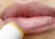 Cum să scapi rapid de herpes. Ce trebuie să știi ca să eviți apariția acestei afecțiuni inestetice 