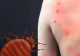 Semne că ai fost mușcat de ploșnițe. Cum să le deosebești de celelalte mușcături de insecte și cum să le tratezi