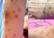 Incident grav, în căminele din Regie: o studentă a ajuns la spital din cauza mușcăturilor de ploșnițe! Administrația, reacție șoc: ”O nespălată!” - FOTO