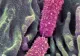 Trăiește în intestine și ar putea avea legătură cu explozia cancerelor colorectale la tineri