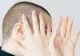 Un îndulcitor natural ar putea ajuta la creșterea părului, în cazul celor care suferă de alopecie, conform unor studii