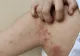 Ce trebuie să știi despre lepră: cum se transmite și ce simptome are? A revenit în România după 44 de ani