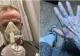 Un bărbat a ajuns la spital după ce s-a trezit complet albastru. Explicația i-a făcut pe medici să râdă