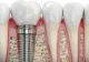Ce contează cu adevărat atunci când pacientul se teme de implant dentar și de procedură