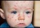 Alertă într-un judeţ din România! Epidemie de varicelă: 70 de copii, bolnavi