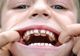 CAZ MEDICAL INCREDIBIL: Copilul cu "DINŢI DE RECHIN"
