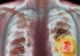 Ai aceste simptome? Ar putea fi cancer pulmonar