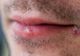 Tot ce trebuie să ştii despre herpes