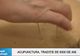 Fresh Refresh. Acupunctura, tradiţie veche de 5000 de ani