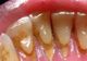 Cea mai eficientă metodă de îndepărtare a tartrului. Nu mai ai nevoie de dentist