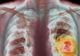 Ai aceste simptome? Ar putea fi cancer pulmonar  