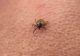Primul caz de boala Lyme din acesta an, din România. Victima, o fetiţă de cinci ani