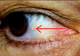 Ai aşa ceva la ochi? Iată ce probleme GRAVE de sănătate indică această pată galbenă