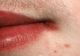 Îţi apar constant crăpături în colţul gurii? Iată cu ce afecţiuni se confruntă corpul tău 
