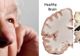 Descoperire de senzație în studiul bolii Alzheimer