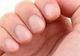 Ce afecțiuni indică unghiile fragile. Semnale pe care le transmite organismul și la care trebuie să fii atent