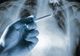 SEMNUL care anunţă cancerul pulmonar