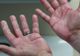 Simptomele cancerului apar prima dată pe mână. Cum arată