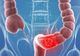 Semnele cancerului de colon pe care NU trebuie să le ignori