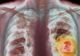 Ai aceste simptome? Ar putea fi cancer pulmonar