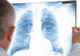 Primele simptome ale tuberculozei. Mergi, de urgență, la medic!
