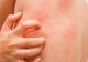 Urticaria acuta. Principalele semne