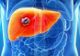 Primele simptome ale cancerului de ficat pe care mulţi le ignoră