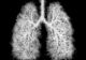 Testul de screening pentru cancerul pulmonar